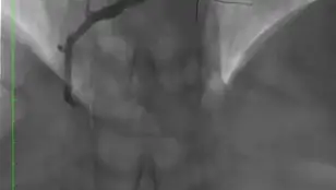 Resultado del fármaco liberado con el balón con la arteria abierta