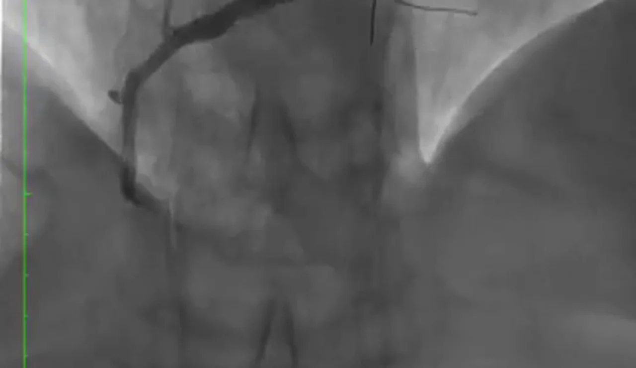 Resultado del fármaco liberado con el balón con la arteria abierta