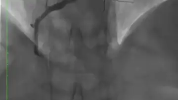 Resultado del fármaco liberado con el balón con la arteria abierta Resultado del fármaco liberado con el balón con la arteria abierta