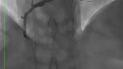 Resultado del fármaco liberado con el balón con la arteria abierta Resultado del fármaco liberado con el balón con la arteria abierta