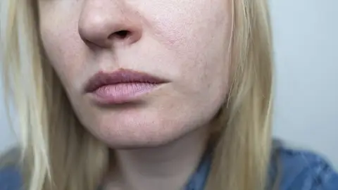 Poros dilatados Poros dilatados