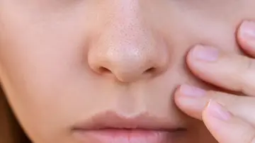 ¿Qué son los filamentos sebáceos? ¿Qué son los filamentos sebáceos?