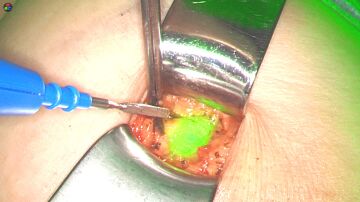 Técnica sin radiación para detectar la extensión del cáncer de mama