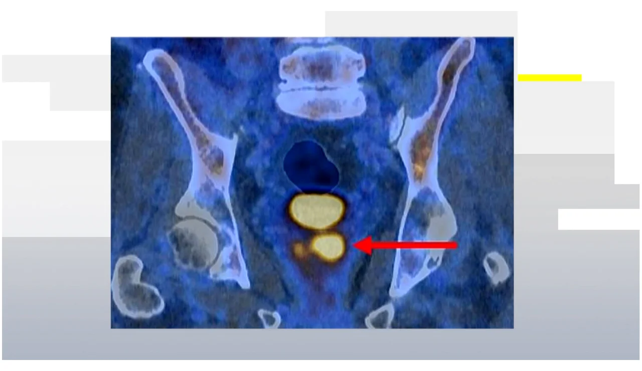 Cáncer de próstata