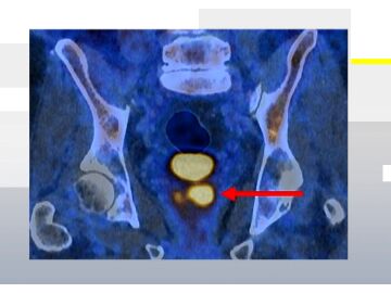 C&aacute;ncer de pr&oacute;stata