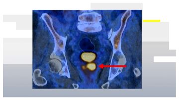 C&aacute;ncer de pr&oacute;stata