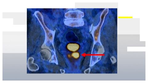 C&aacute;ncer de pr&oacute;stata