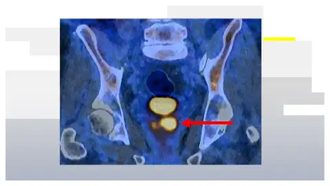 Cáncer de próstata Cáncer de próstata