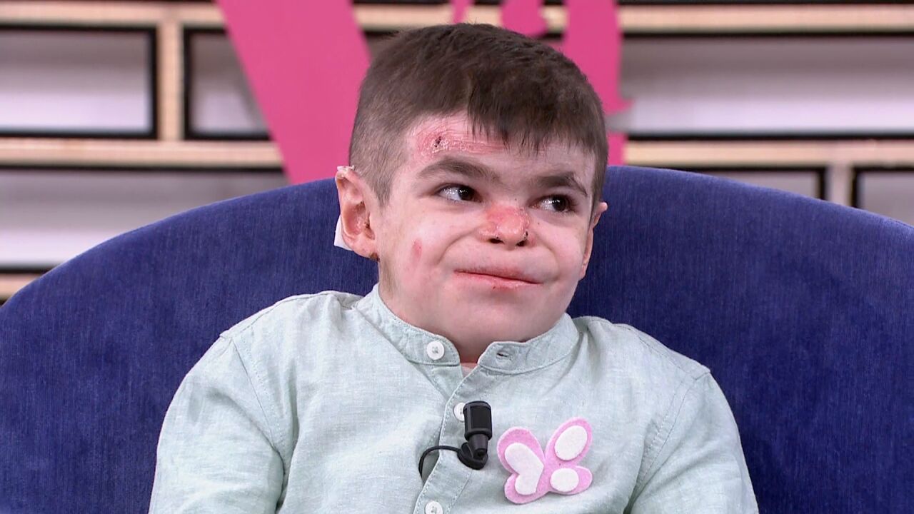 Leo, niño con piel de mariposa