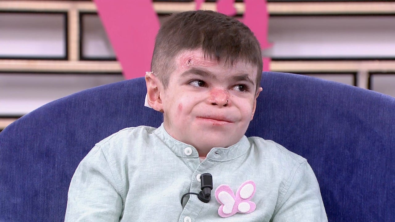 Leo, niño con piel de mariposa