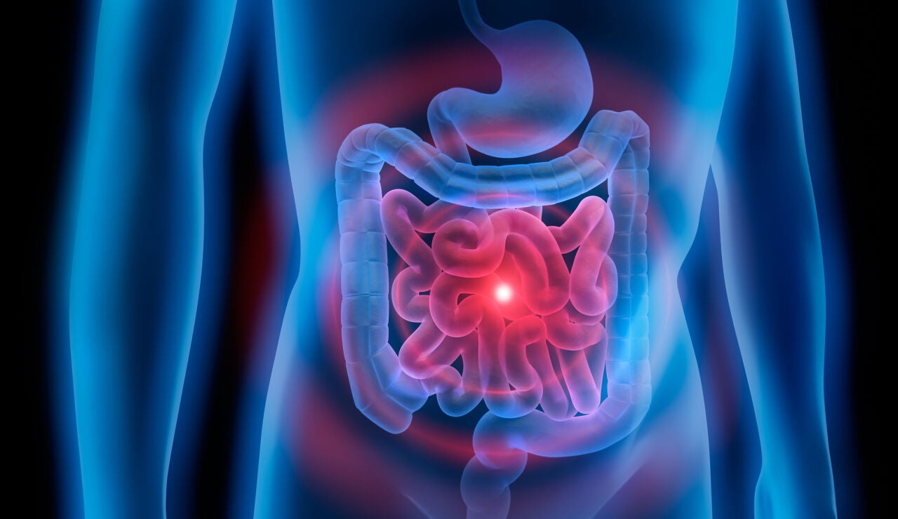 C&aacute;ncer de colon