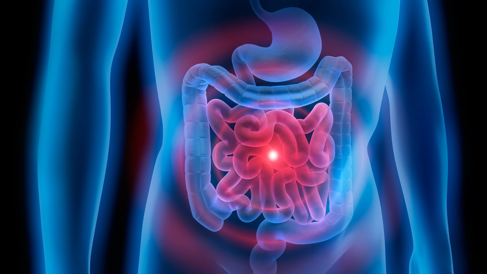 Cáncer de colon Cáncer de colon