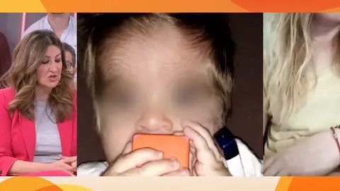 Síndrome de hombre lobo Síndrome de hombre lobo