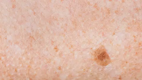 Mancha en la piel Mancha en la piel