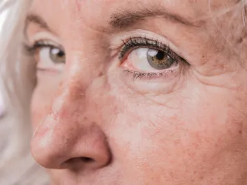 Manchas en la piel Manchas en la piel