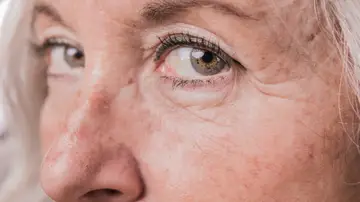 Manchas en la piel Manchas en la piel