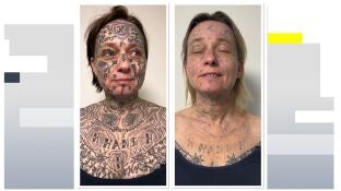 Imagen del antes y despu&eacute;s de la mujer tras someterse a las sesiones de l&aacute;ser para eliminar los tatuajes