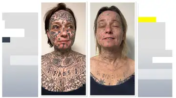 Imagen del antes y después de la mujer tras someterse a las sesiones de láser para eliminar los tatuajes Imagen del antes y después de la mujer tras someterse a las sesiones de láser para eliminar los tatuajes