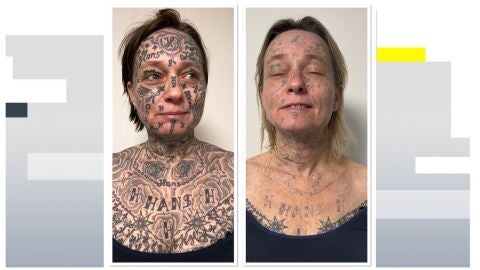Imagen del antes y despu&eacute;s de la mujer tras someterse a las sesiones de l&aacute;ser para eliminar los tatuajes