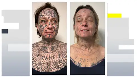 Imagen del antes y después de la mujer tras someterse a las sesiones de láser para eliminar los tatuajes Imagen del antes y después de la mujer tras someterse a las sesiones de láser para eliminar los tatuajes