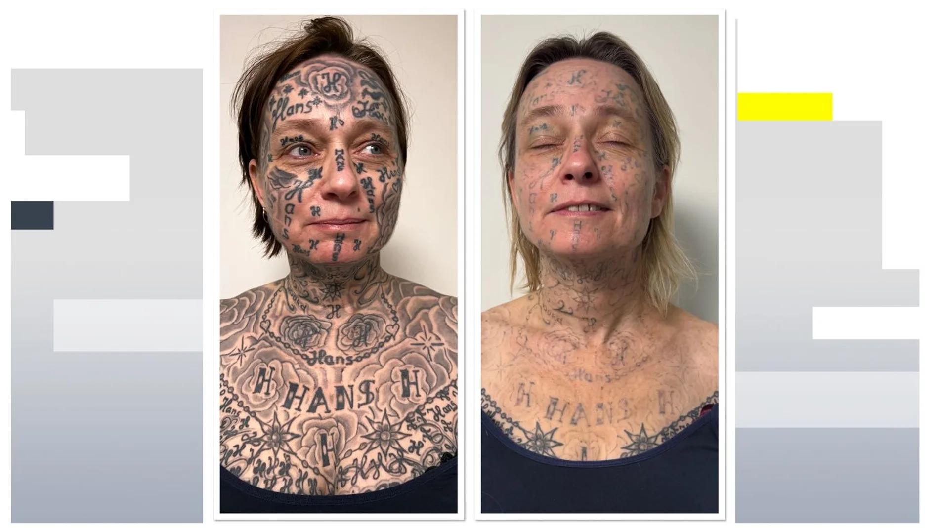Imagen del antes y después de la mujer tras someterse a las sesiones de láser para eliminar los tatuajes Imagen del antes y después de la mujer tras someterse a las sesiones de láser para eliminar los tatuajes