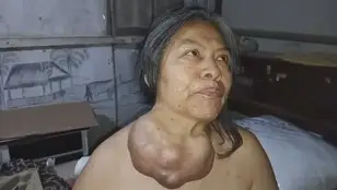 Extirpan un tumor gigante que asfixiaba a una mujer tras 38 años creciendo en su cuello
