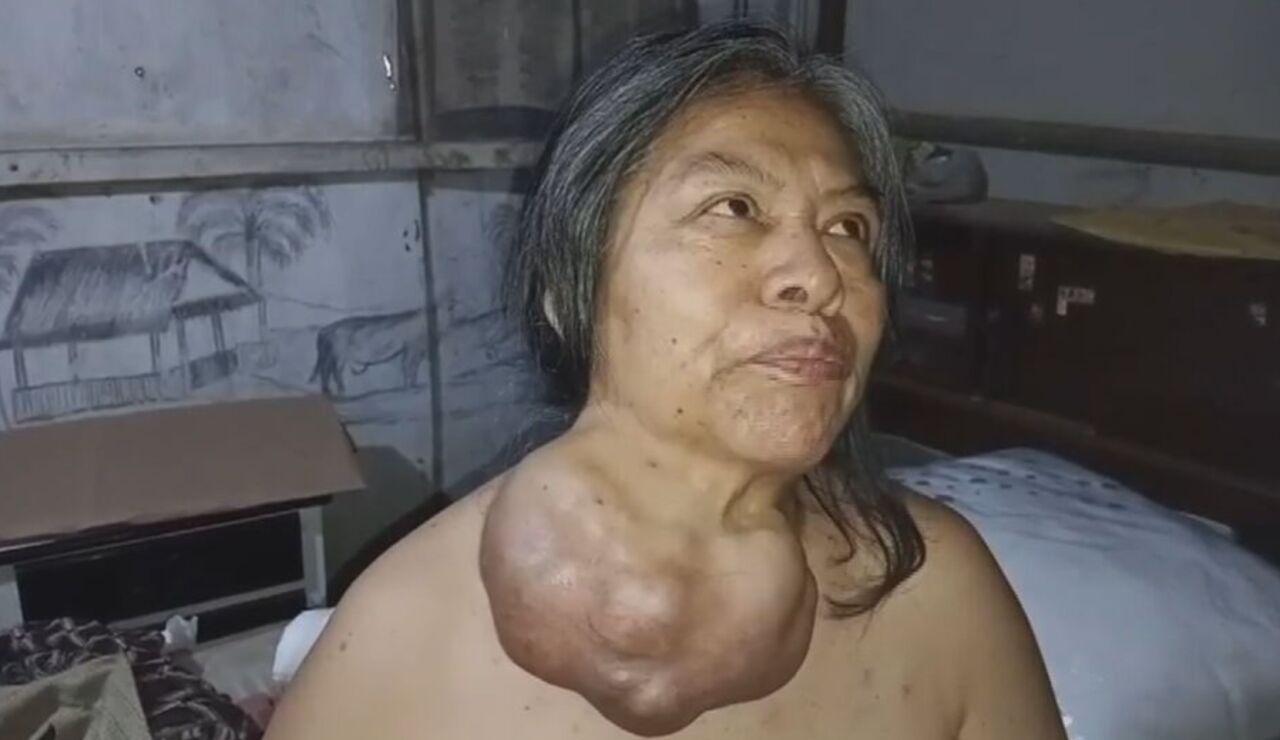 Extirpan un tumor gigante que asfixiaba a una mujer tras 38 a&ntilde;os creciendo en su cuello