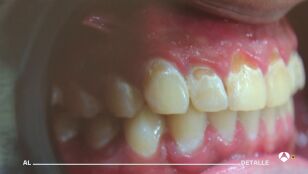 Los dentistas alertan de los efectos de vapear en la salud bucodental