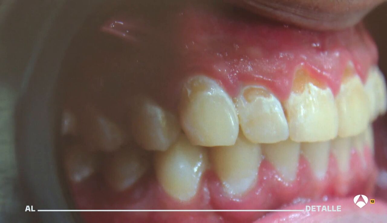 Los dentistas alertan de los efectos de vapear en la salud bucodental