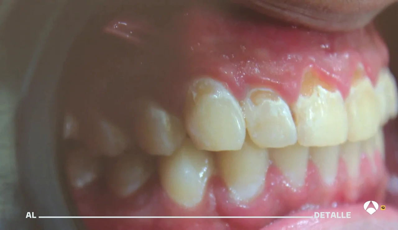 Los dentistas alertan de los efectos de vapear en la salud bucodental