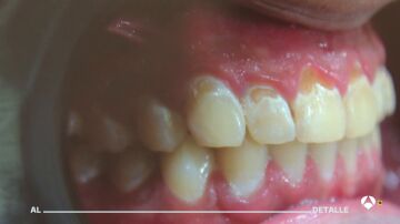 Los dentistas alertan de los efectos de vapear en la salud bucodental