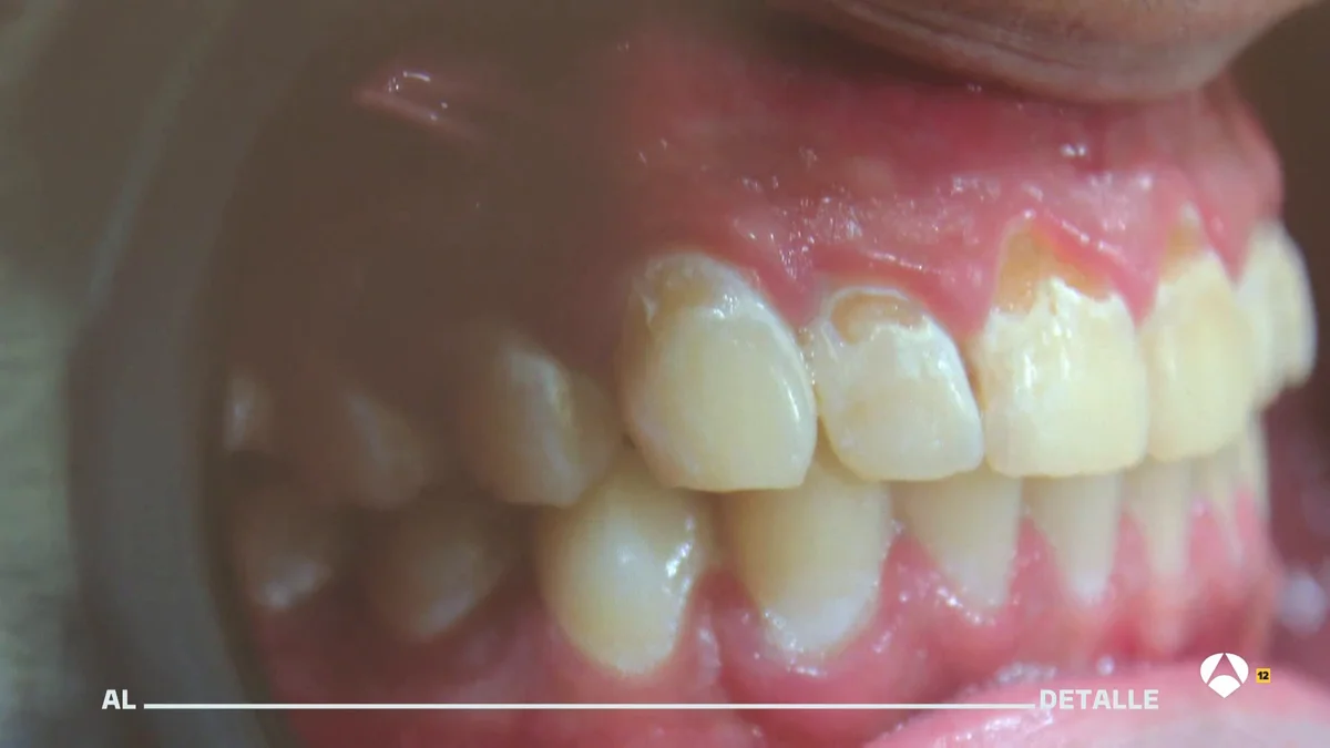 El vaper causa sequedad que conlleva ms caries y genera irritacin El vaper causa sequedad que conlleva ms caries y genera irritacin