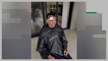 Primera imagen de la cicatriz de Valverde tras su pelea con Tchouam&eacute;ni