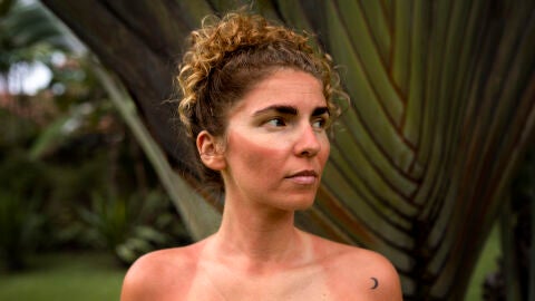 Mujer quemada por exposición solar