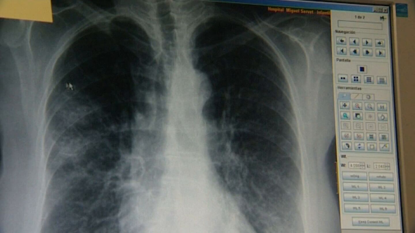 Un equipo de investigadores descubre una prote&iacute;na que aporta m&aacute;s informaci&oacute;n sobre el c&aacute;ncer de pulm&oacute;n