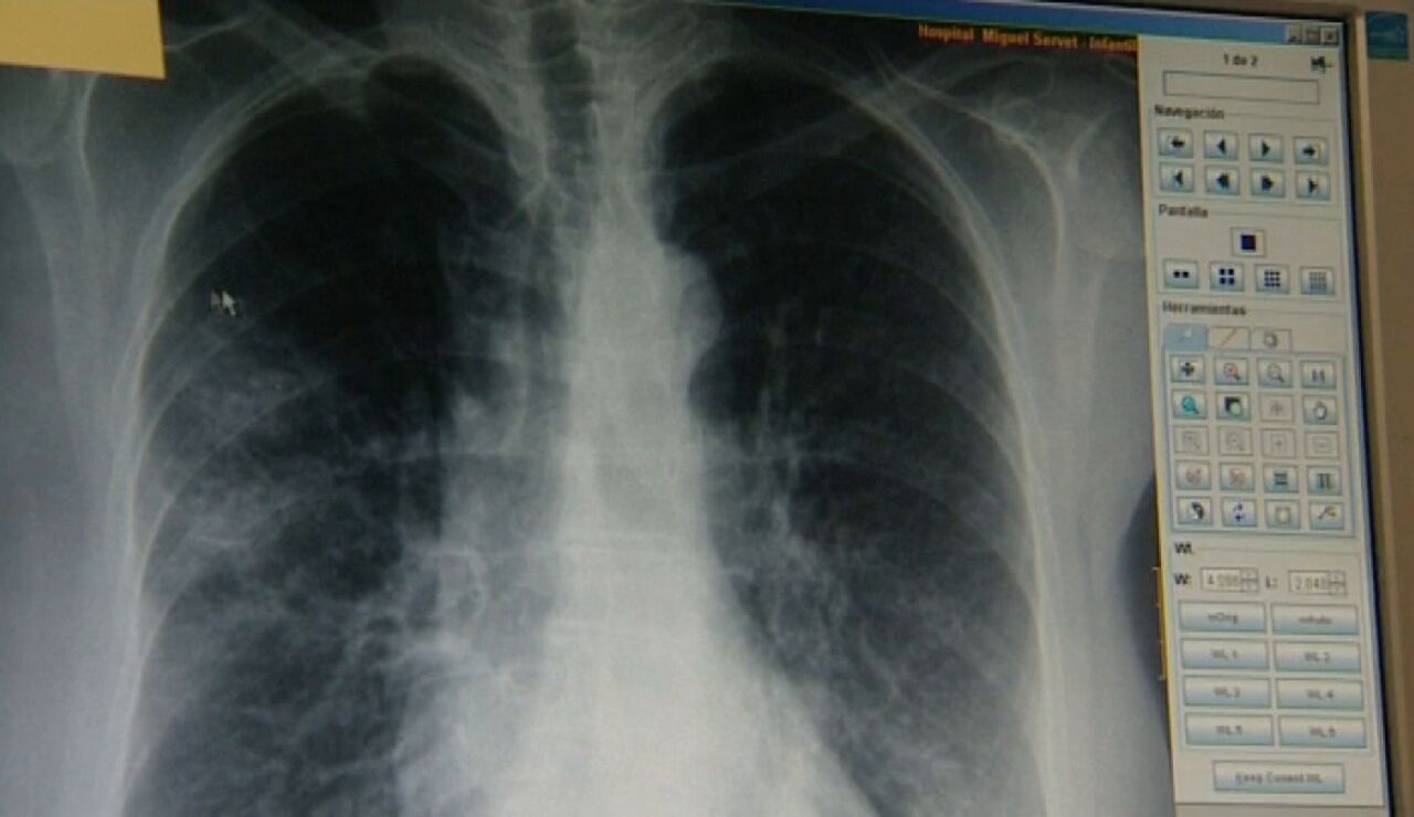 Un equipo de investigadores descubre una prote&iacute;na que aporta m&aacute;s informaci&oacute;n sobre el c&aacute;ncer de pulm&oacute;n