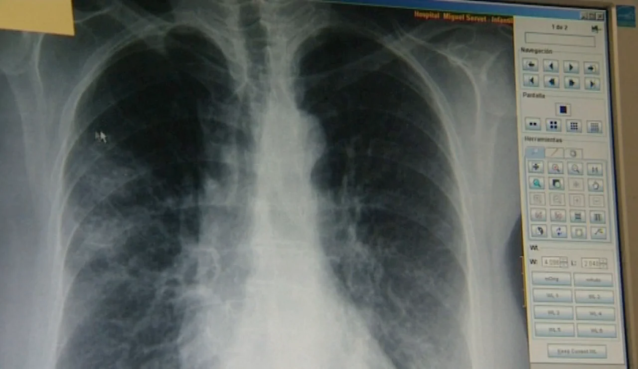 Un equipo de investigadores descubre una proteína que aporta más información sobre el cáncer de pulmón