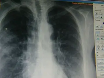 Un equipo de investigadores descubre una proteína que aporta más información sobre el cáncer de pulmón Un equipo de investigadores descubre una proteína que aporta más información sobre el cáncer de pulmón