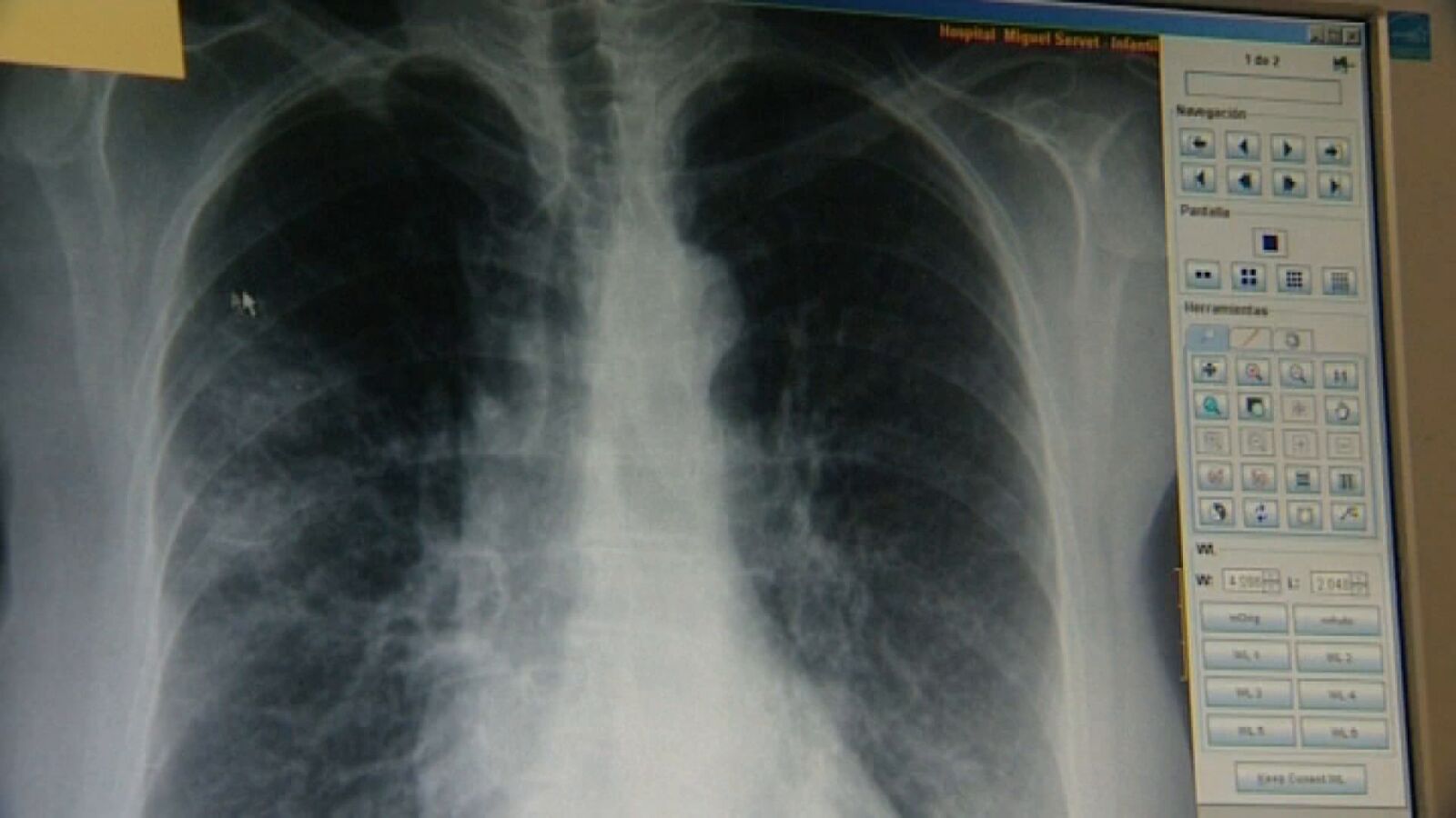 Un equipo de investigadores descubre una proteína que aporta más información sobre el cáncer de pulmón