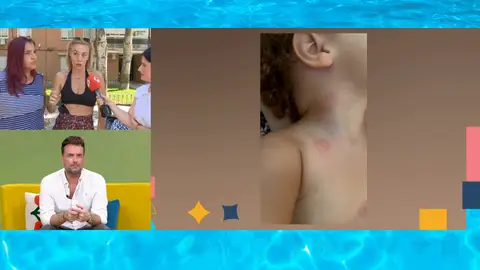 Una niña de 22 meses, llena de picaduras de avispa Una niña de 22 meses, llena de picaduras de avispa