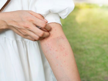 Picaduras en el brazo