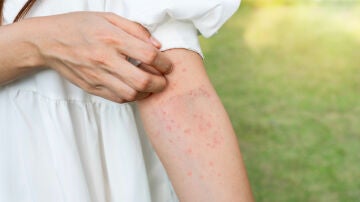 Picaduras en el brazo