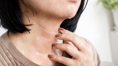 Hiperhidrosis: los mejores tratamientos para controlar el exceso de sudor todo el año