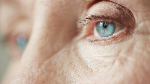 Mujer con arrugas en la zona de las ojeras