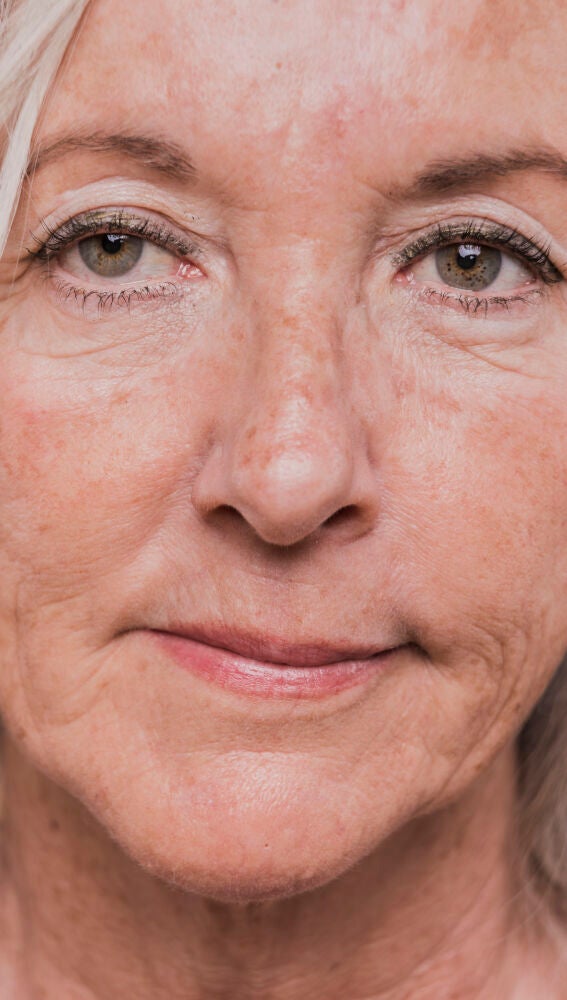 Mujer mayor con manchas solares