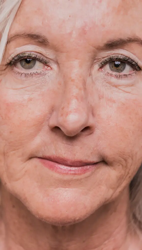 Mujer mayor con manchas solares Mujer mayor con manchas solares