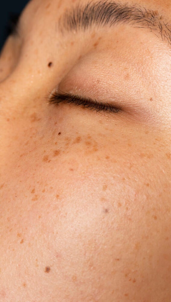 Mujer con manchas solares