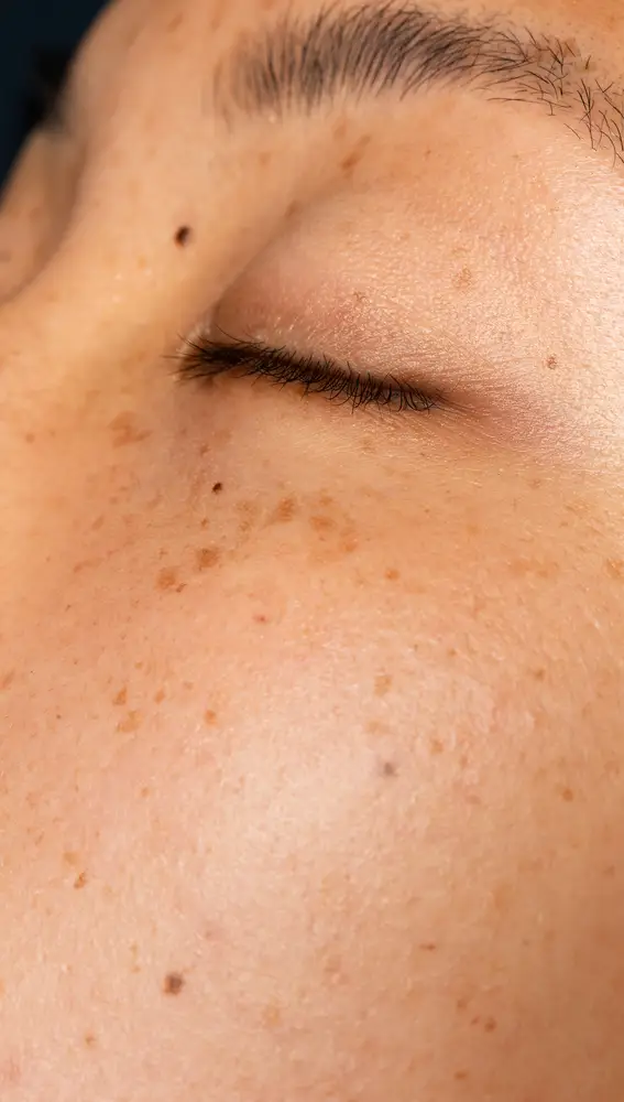 Mujer con manchas solares Mujer con manchas solares