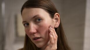 Mujer con irritaci&oacute;n en el rostro