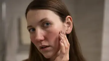 Mujer con irritación en el rostro Mujer con irritación en el rostro